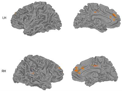 Emotion-related impulsivity and suicidal ideation and behavior in schizophrenia spectrum disorder: a pilot fMRI study